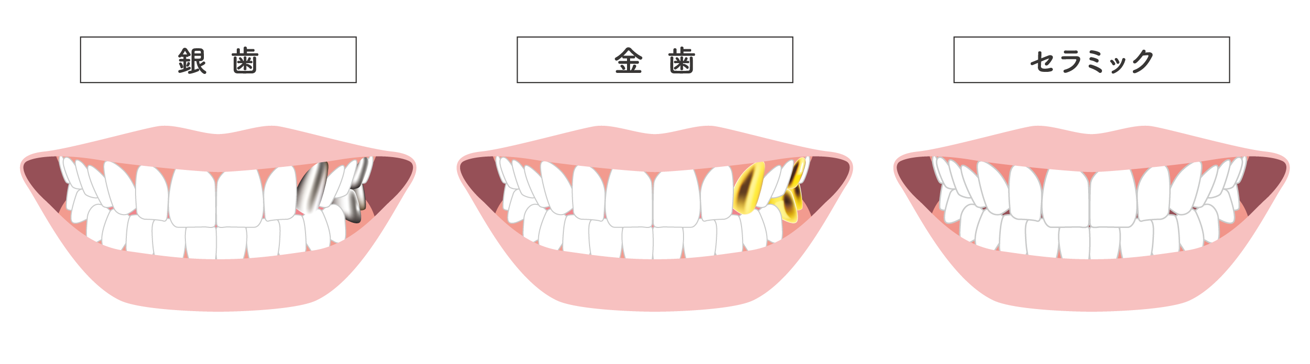 銀歯、金歯、セラミックの被せ物イメージ