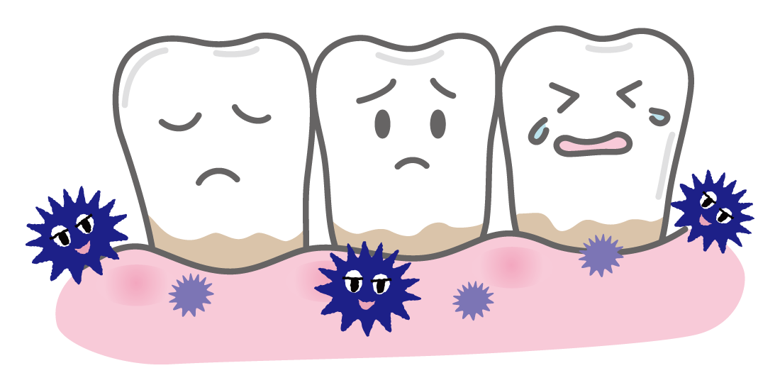 歯周病の進行