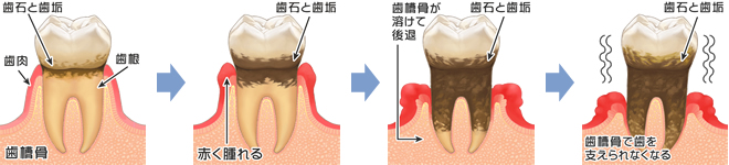 歯周病の進行