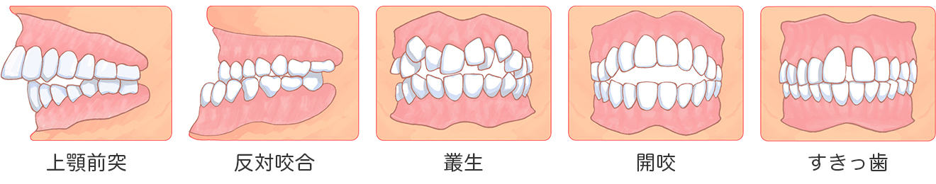 悪い歯並び・不正歯列